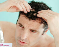 Выпадение волос у мужчин: признаки, причины, лечение