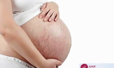Борьба с растяжками на животе после родов: проверенные домашние методы